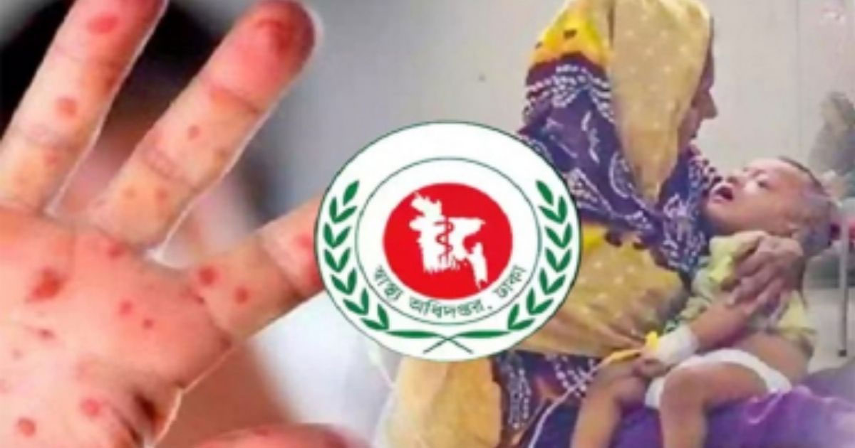 বাড়ছে হামের ভয়াবহতা, মৃত্যু ছাড়াল ৪০০