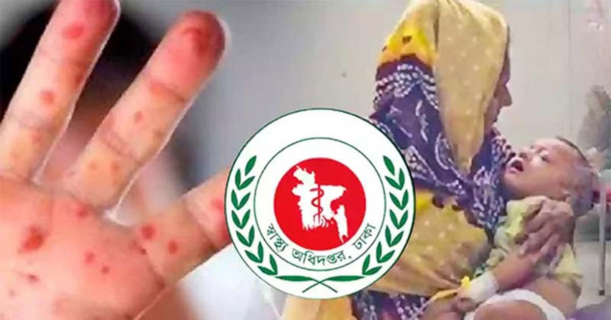 হাম উপসর্গে আরও ৩ মৃত্যু