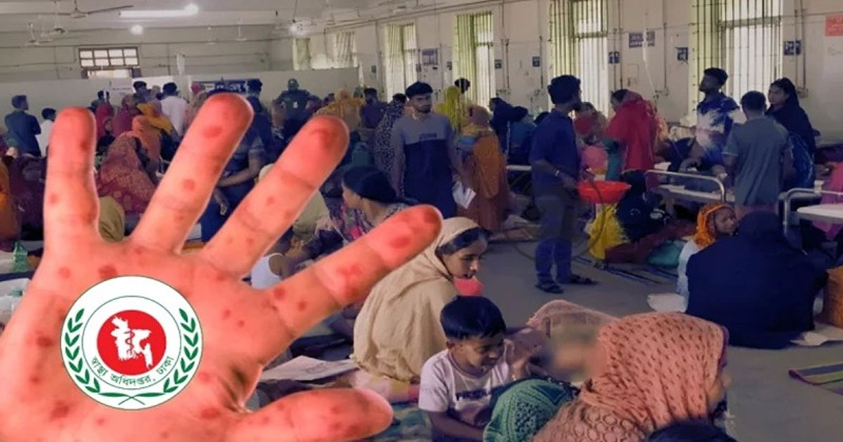 হাম ও উপসর্গে আরও ৮ শিশুর মৃত্যু